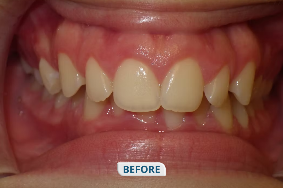 Before treatment at Namira Oro Dental Care